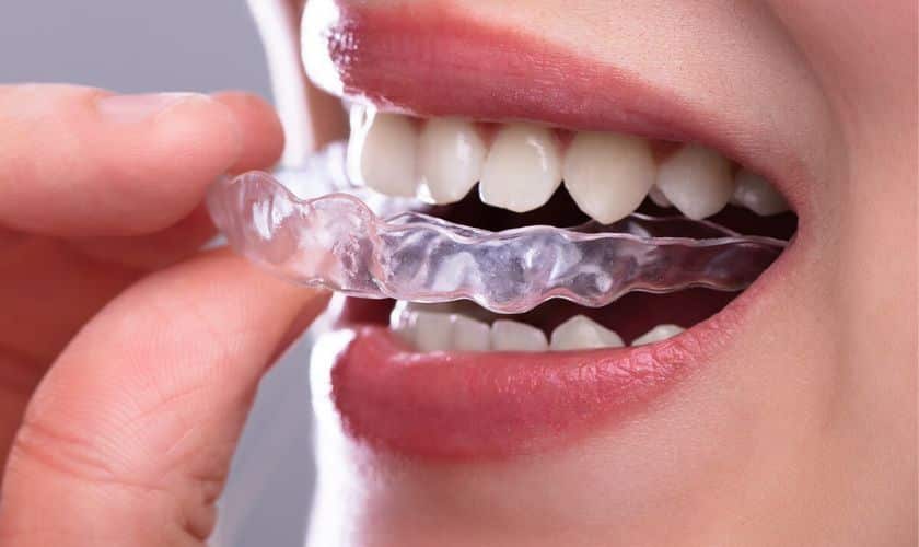 Invisalign in Jericho