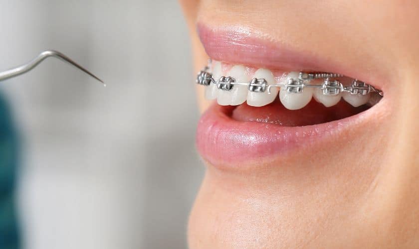 Your Comprehensive Guide For Adjusting to Braces