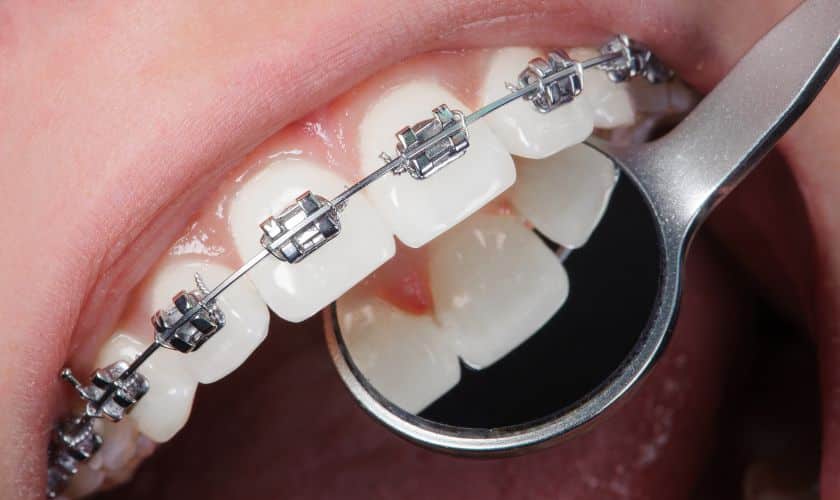 The Impact of Braces on Oral Health: A Guide by Khan Orthodontic Group