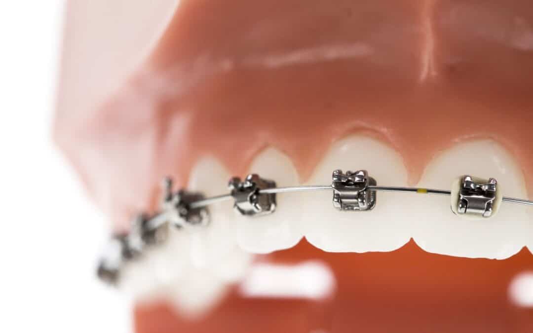 How to Avoid Staining Your Teeth with Braces