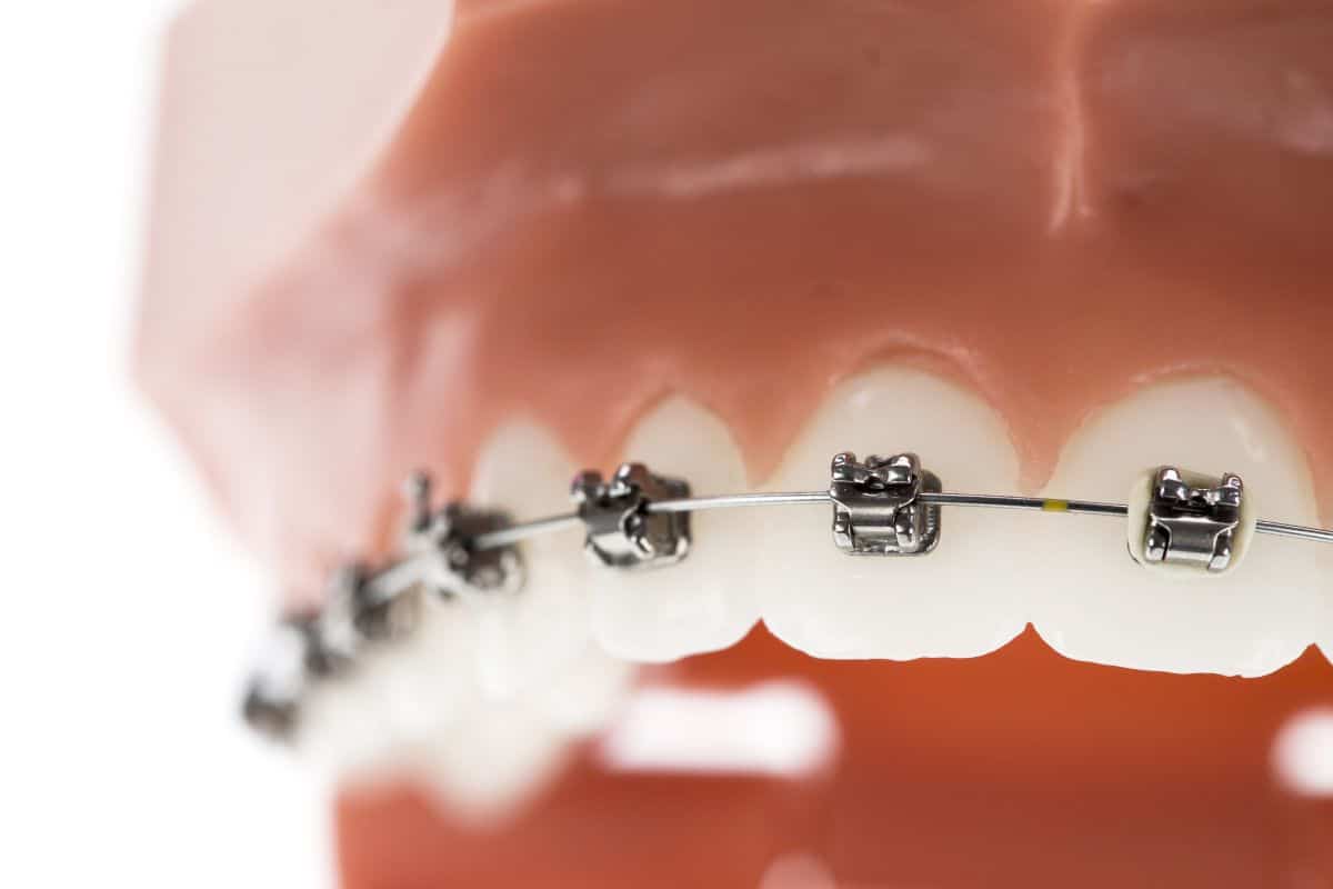 Braces In Maspeth